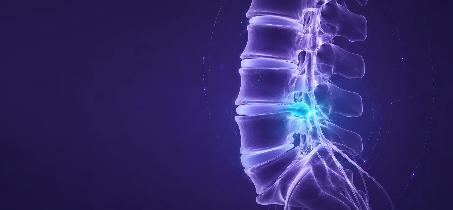 Ilustración de columna vertebral con hernia de disco, especialista en Monterrey